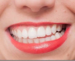 親知らずが及ぼす歯並びへの影響について